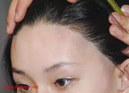 发际线是什么
