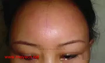 发际线如何让你变美,发际线