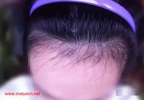 论发际线怎么让你变美！