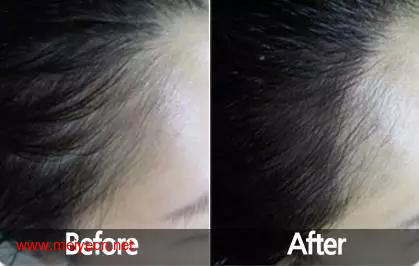 论发际线怎么让你变美！