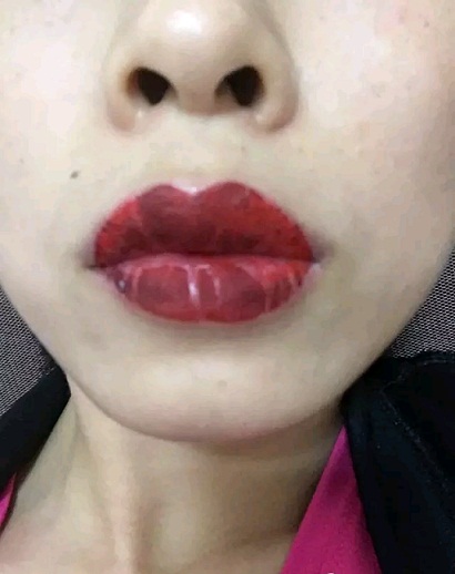 如做唇后嘴唇干,脱皮伴随轻微红肿,痛(唇线边缘痛)是唇炎现象,属于