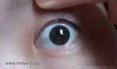 美瞳线结痂不能抠，谁抠谁后悔！