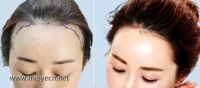发际线高怎么办,半永久纹发际线