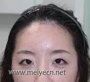 发际线高怎么办,半永久纹发际线